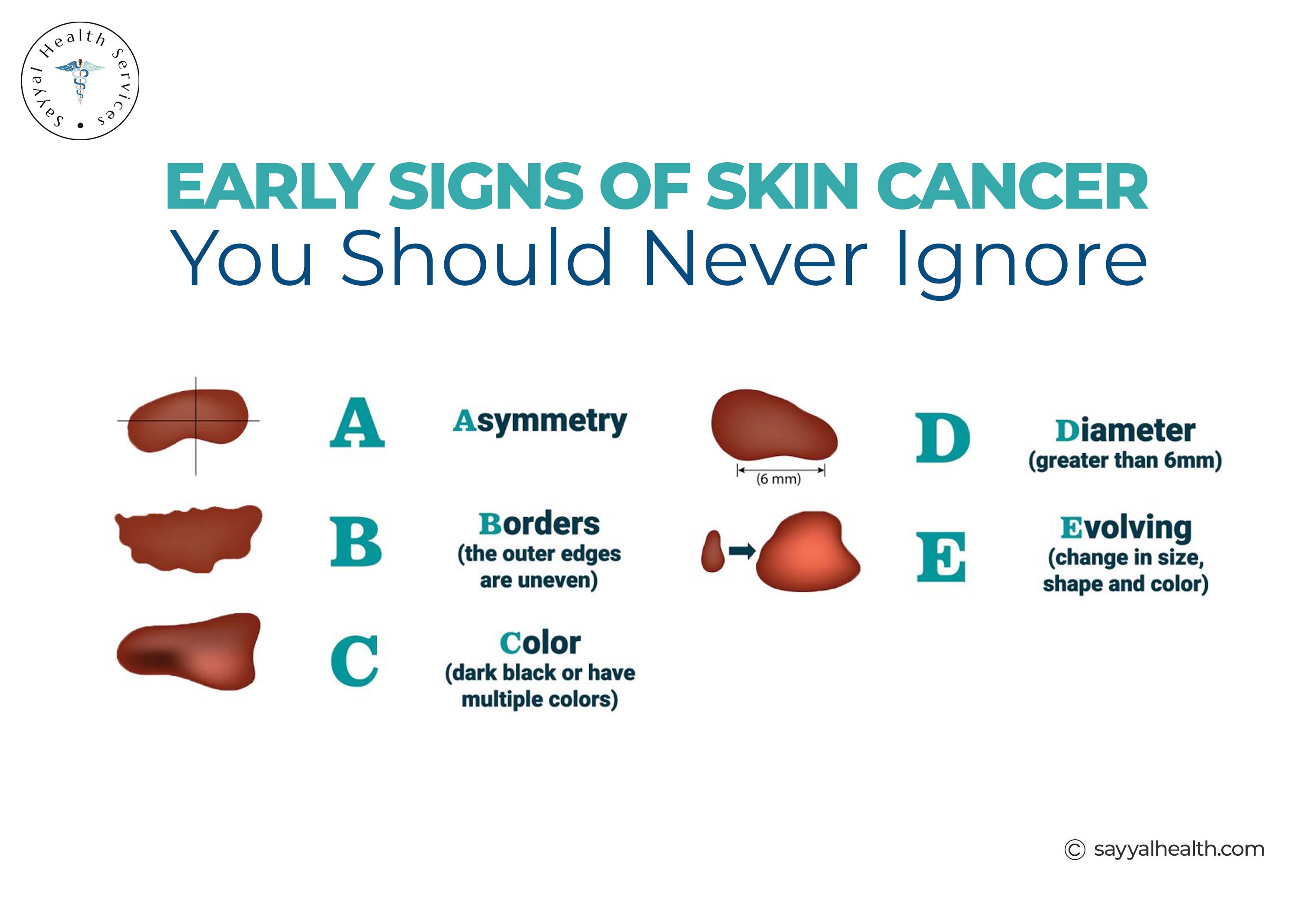 Image is about the ABCDE rule detection of Melanoma.